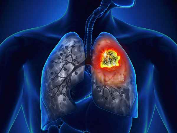 lung_cancer.jpg