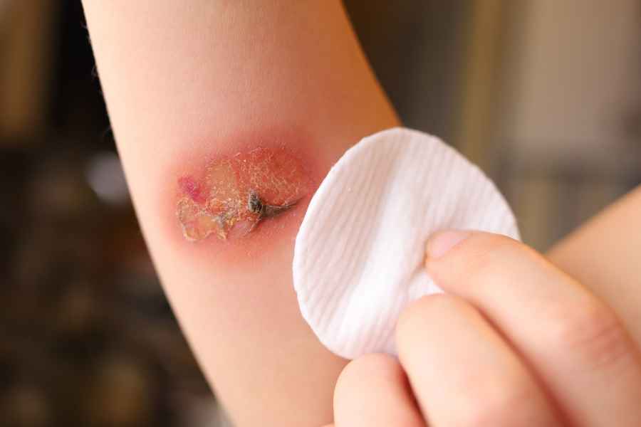 Stem cells could create new skin to help burns victims